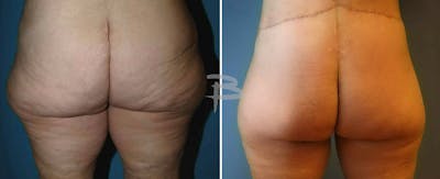 Body Contouring After Weight Loss Before & After Gallery - Patient 192277424 - Image 1