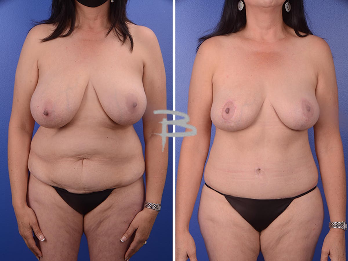 Mommy Makeover Before & After Gallery - Patient 192277427 - Image 1