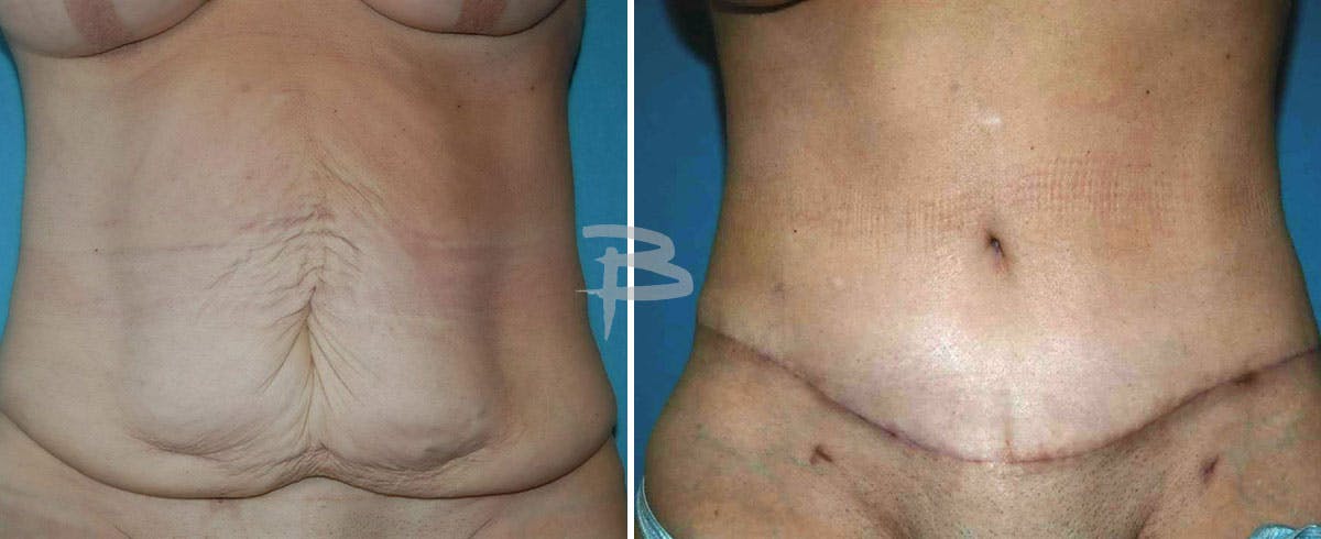 Body Contouring After Weight Loss Before & After Gallery - Patient 192277438 - Image 1