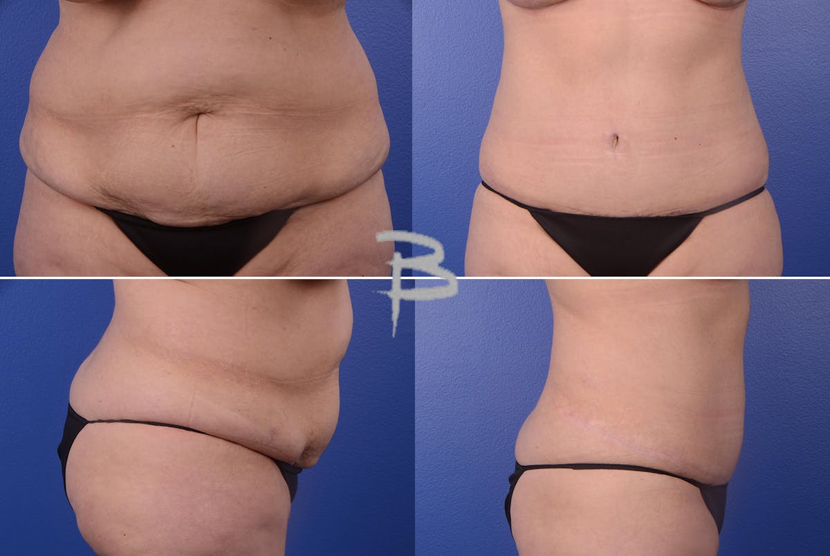 Revisionary Tummy Tuck Before & After Gallery - Patient 192277451 - Image 1
