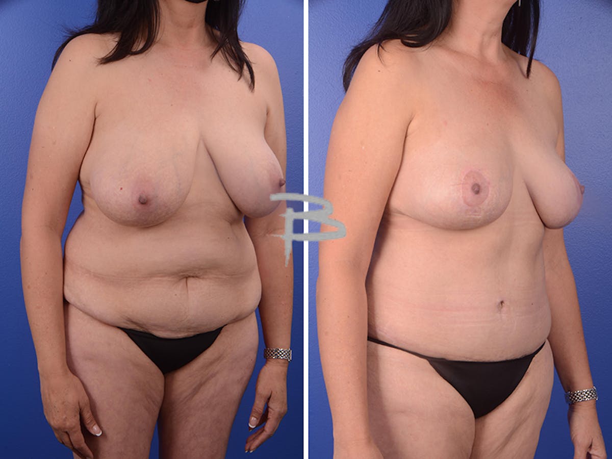 Mommy Makeover Before & After Gallery - Patient 192277445 - Image 1