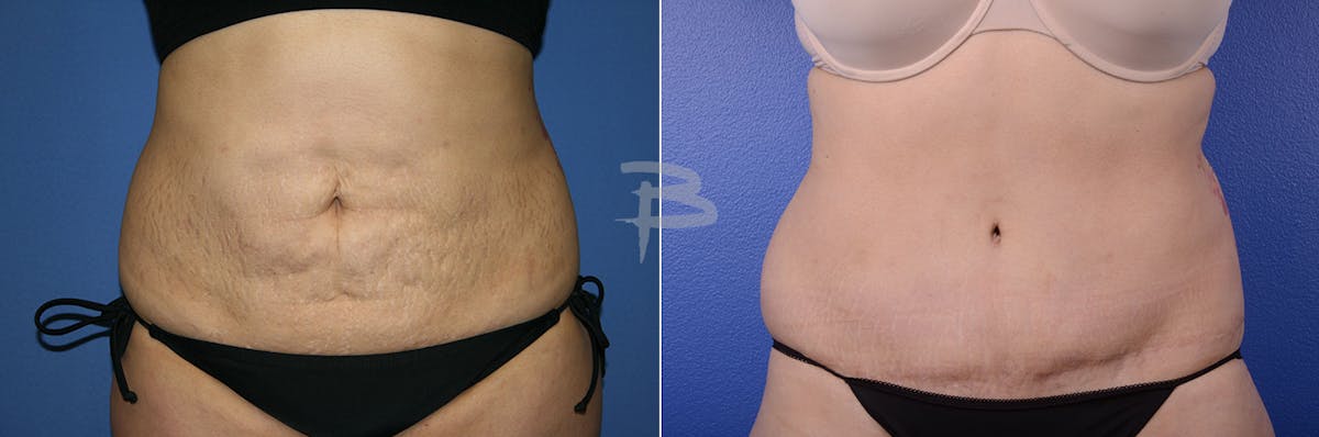 Abdominoplasty Before & After Gallery - Patient 192277442 - Image 1