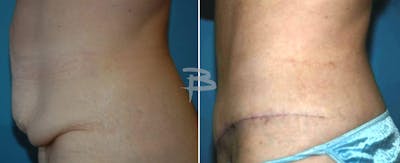 Body Contouring After Weight Loss Before & After Gallery - Patient 192277449 - Image 1