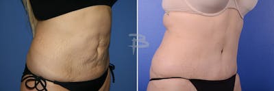 Abdominoplasty Before & After Gallery - Patient 192277454 - Image 1