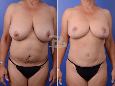 Mommy Makeover Before & After Gallery - Patient 192277468 - Image 1