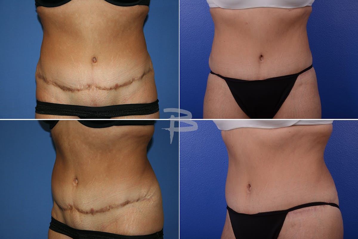 Revisionary Tummy Tuck Before & After Gallery - Patient 192277488 - Image 1