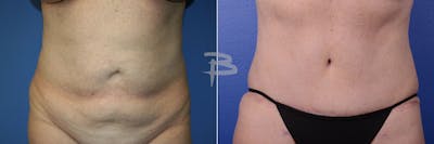 Abdominoplasty Before & After Gallery - Patient 192277502 - Image 1