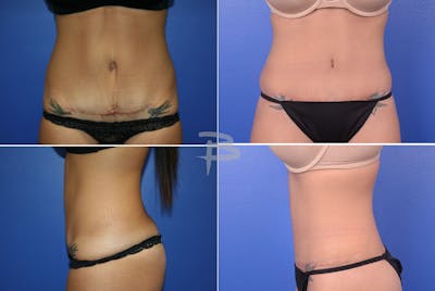 Revisionary Tummy Tuck Before & After Gallery - Patient 192277546 - Image 1