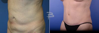 Abdominoplasty Before & After Gallery - Patient 192277547 - Image 1