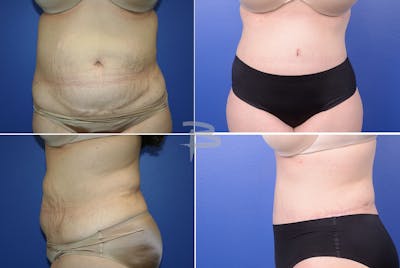 Revisionary Tummy Tuck Before & After Gallery - Patient 192277611 - Image 1