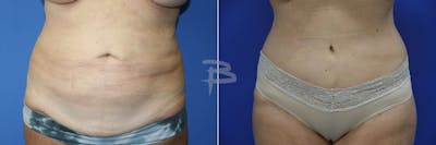 Abdominoplasty Before & After Gallery - Patient 192277610 - Image 1
