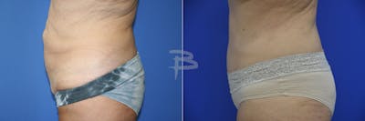 Abdominoplasty Before & After Gallery - Patient 192277697 - Image 1
