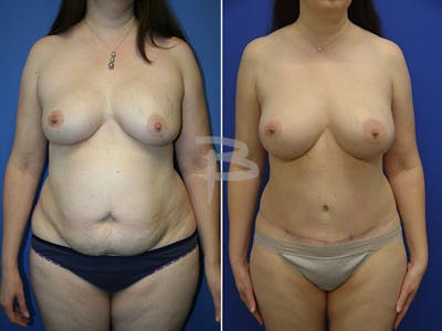Mommy Makeover Before & After Gallery - Patient 192277744 - Image 1