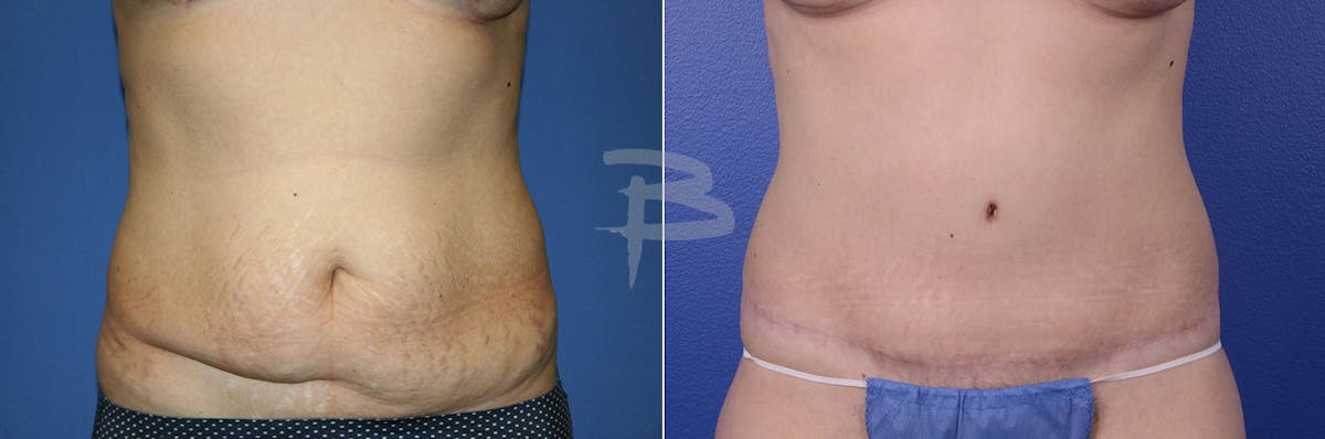 Abdominoplasty Before & After Gallery - Patient 192277758 - Image 1