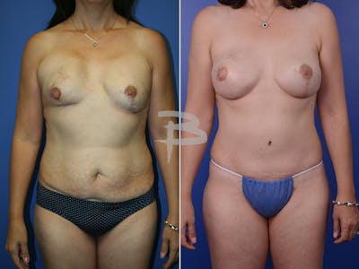 Mommy Makeover Before & After Gallery - Patient 192277835 - Image 1