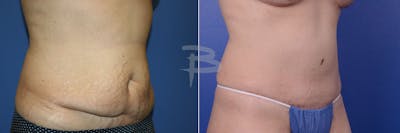 Abdominoplasty Before & After Gallery - Patient 192277814 - Image 1
