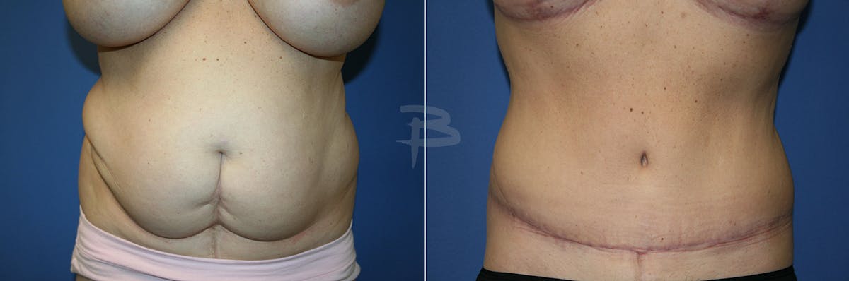 Abdominoplasty Before & After Gallery - Patient 192277855 - Image 1