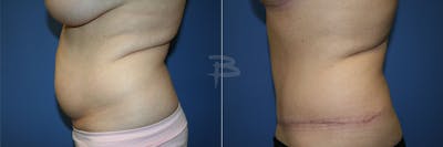 Abdominoplasty Before & After Gallery - Patient 192277889 - Image 1
