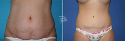 Abdominoplasty Before & After Gallery - Patient 192277915 - Image 1
