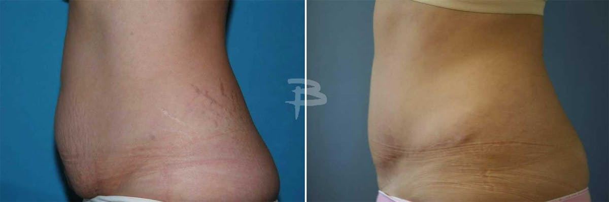 Abdominoplasty Before & After Gallery - Patient 192277926 - Image 1