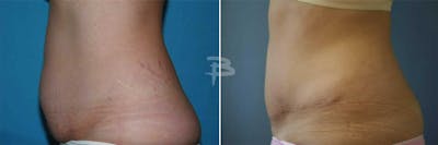 Abdominoplasty Before & After Gallery - Patient 192277926 - Image 1