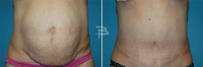 Abdominoplasty Before & After Gallery - Patient 192277943 - Image 1