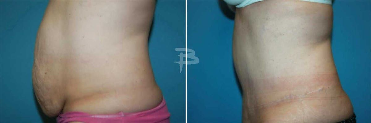 Abdominoplasty Before & After Gallery - Patient 192277975 - Image 1