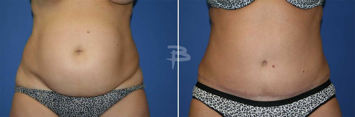 Abdominoplasty Before & After Gallery - Patient 192278025 - Image 1