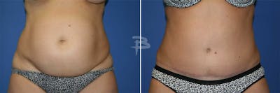 Abdominoplasty Before & After Gallery - Patient 192278025 - Image 1