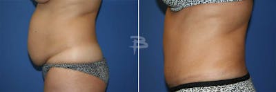 Abdominoplasty Before & After Gallery - Patient 192278056 - Image 1