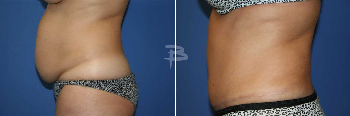 Abdominoplasty Before & After Gallery - Patient 192278056 - Image 1