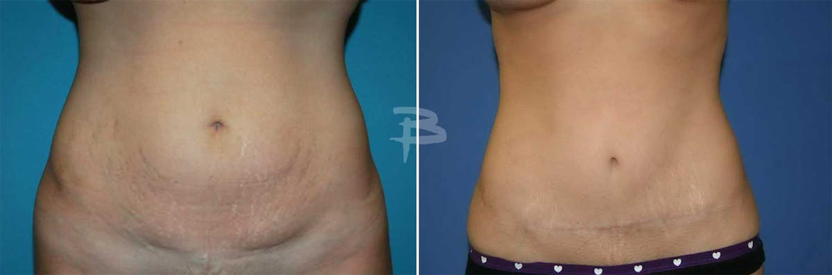 Abdominoplasty Before & After Gallery - Patient 192278064 - Image 1