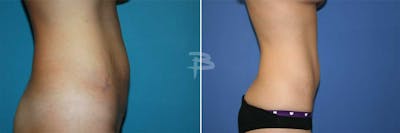 Abdominoplasty Before & After Gallery - Patient 192278067 - Image 1