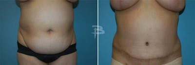 Abdominoplasty Before & After Gallery - Patient 192278079 - Image 1
