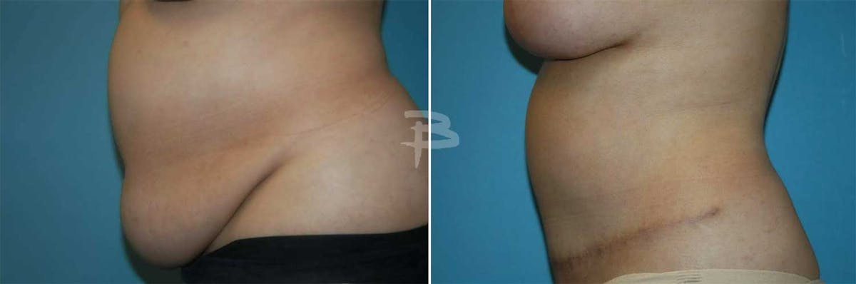 Abdominoplasty Before & After Gallery - Patient 192278081 - Image 1