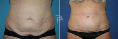 Abdominoplasty Before & After Gallery - Patient 192278082 - Image 1