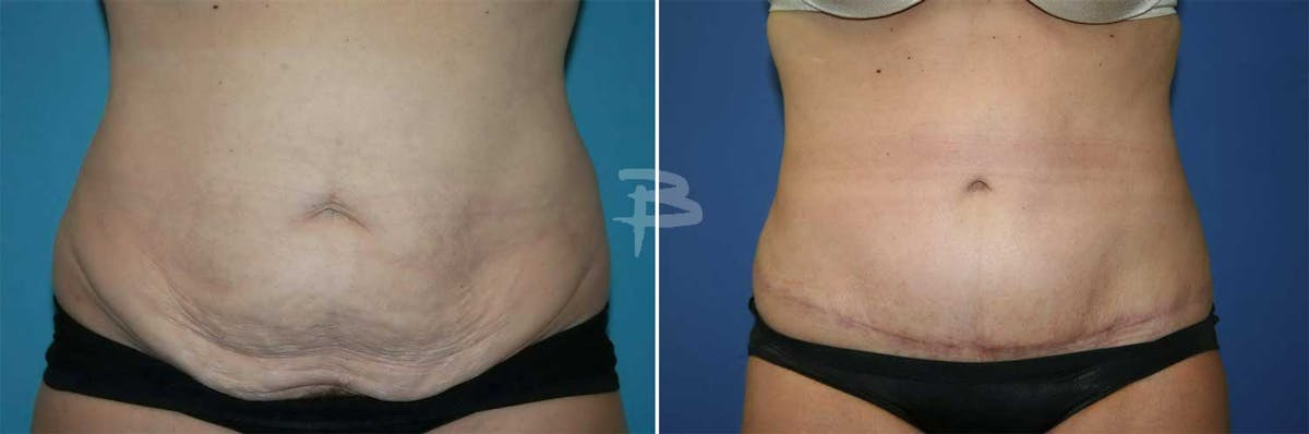 Abdominoplasty Before & After Gallery - Patient 192278082 - Image 1