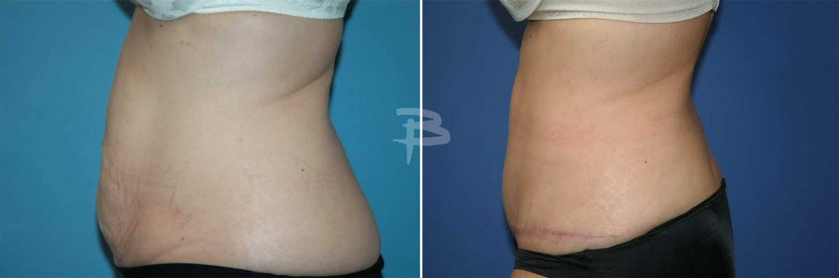 Abdominoplasty Before & After Gallery - Patient 192278087 - Image 1