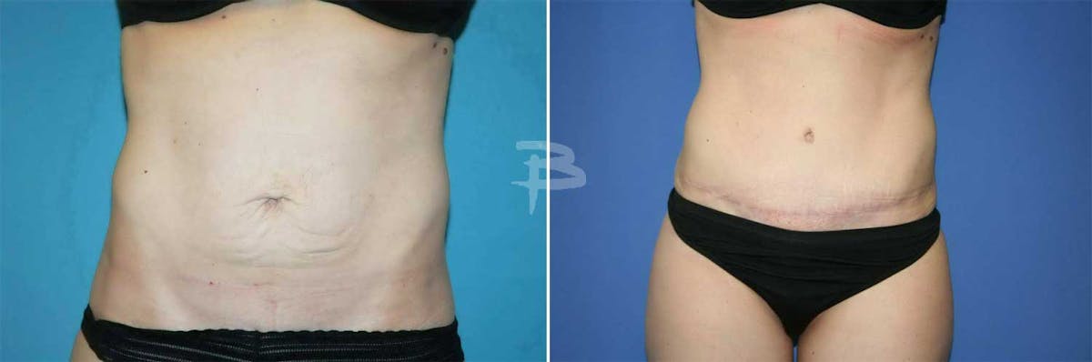 Abdominoplasty Before & After Gallery - Patient 192278088 - Image 1