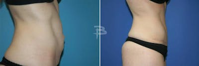 Abdominoplasty Before & After Gallery - Patient 192278111 - Image 1