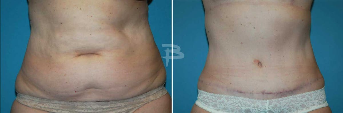 Abdominoplasty Before & After Gallery - Patient 192278113 - Image 1