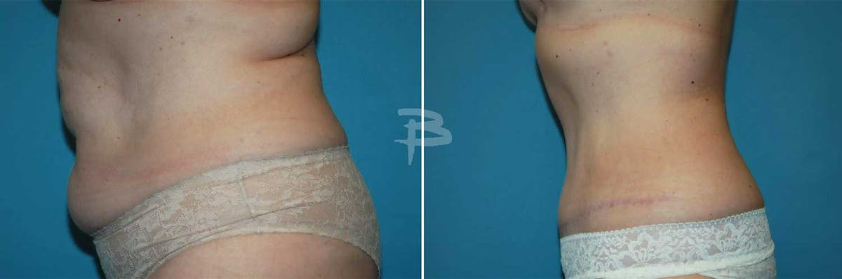 Abdominoplasty Before & After Gallery - Patient 192278114 - Image 1