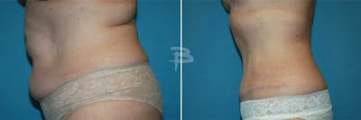 Abdominoplasty Before & After Gallery - Patient 192278114 - Image 1