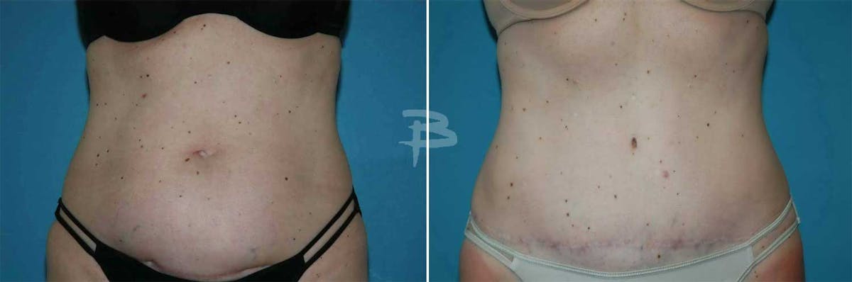Abdominoplasty Before & After Gallery - Patient 192278116 - Image 1