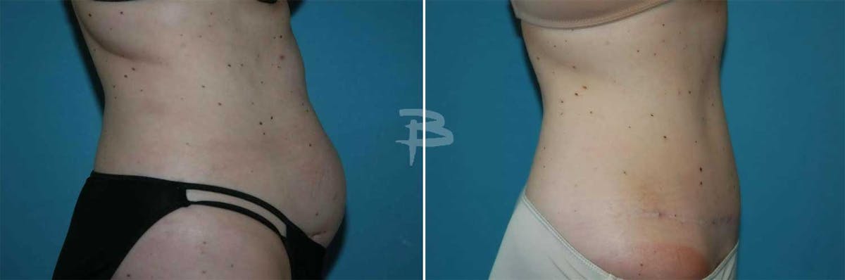 Abdominoplasty Before & After Gallery - Patient 192278117 - Image 1