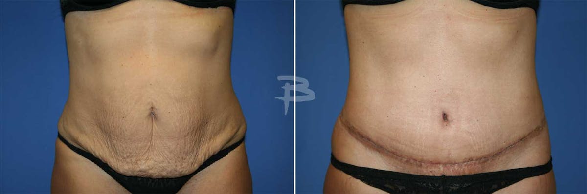 Abdominoplasty Before & After Gallery - Patient 192278118 - Image 1