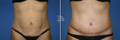 Abdominoplasty Before & After Gallery - Patient 192278118 - Image 1