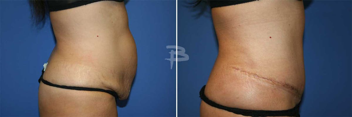 Abdominoplasty Before & After Gallery - Patient 192278119 - Image 1