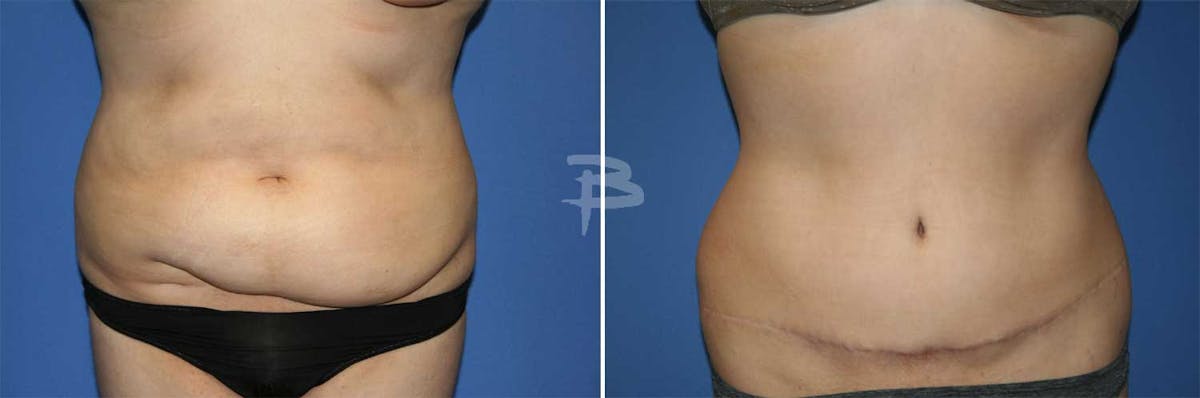 Abdominoplasty Before & After Gallery - Patient 192278120 - Image 1