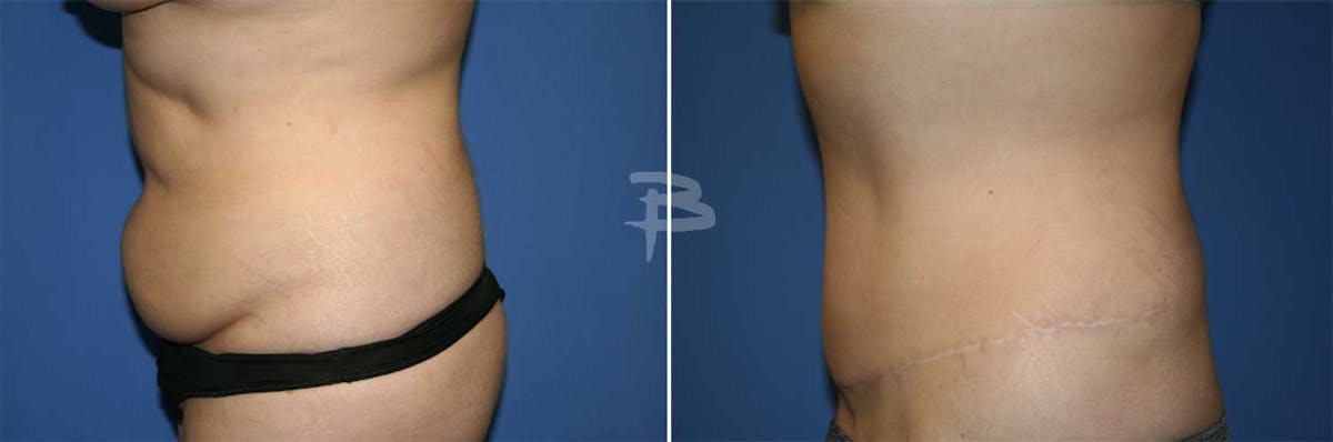 Abdominoplasty Before & After Gallery - Patient 192278121 - Image 1